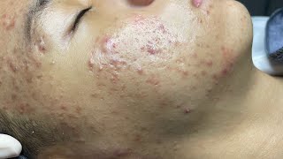 ACNE TREATMENT VU QUYNH MI  Perennial Blackheads On Boy Face 2024FULL [upl. by Anin]