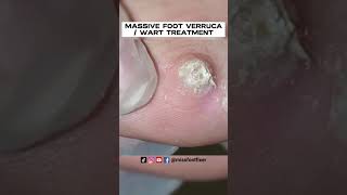 PATIENT MIGHT USING BAZUKA MASSIVE FOOT VERRUCA  WART TREATMENT BY PODIATRIST MISS FOOT FIXER [upl. by Aihsoek615]