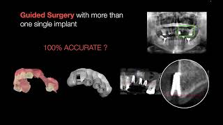 ACCURACY OF GUIDED SURGERY COMMON MISTAKES PART 2 [upl. by Manoop]