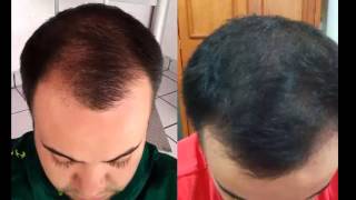 Shampoo folicure no funciona  Regenerador capilar rc  caida de cabello [upl. by Shannan]