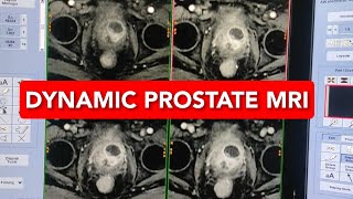 Dynamic Prostate Mri scan [upl. by Fionnula]