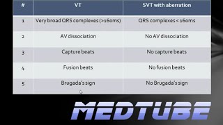 VT vs SVT with aberrancy Made Easy [upl. by Bishop]