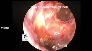 Ear wax removalManagement of a severe external auditory canal cholesteatoma 11 min [upl. by Reviere]