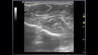 Medial Nerve  wrist to elbow Sonoanatomy  QMH AED Ultrasound Casebook 2013 Video 11 [upl. by Leamiba141]