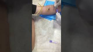 Butteefly needle bloodtest butterfly hospital butterflyneedle doctor [upl. by Annaoj]