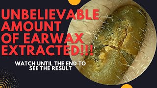 UNBELIEVABLE Amount Of Earwax Extracted From This Ear Watch Until The End [upl. by Elayor]