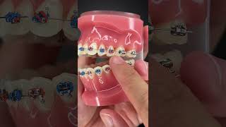 How to Floss Properly with Braces On [upl. by Lraep]