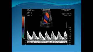 Obstetric Doppler Part 1 [upl. by Arev]