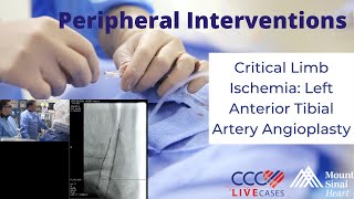 Critical Limb Ischemia Left Anterior Tibial Artery Angioplasty  March 28 2018 [upl. by Moguel]