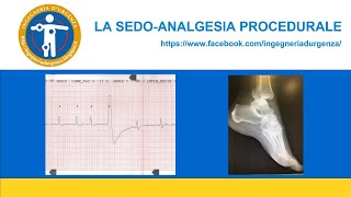 La sedoanalgesia procedurale in urgenza [upl. by Irianat]