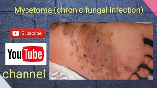 Mycetoma chronic fungal infection [upl. by Remliw288]