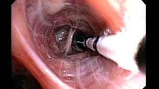 Bronchial Thermoplasty Improved Asthma Control for your Patients [upl. by Stevenson]