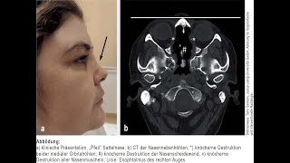 Orbitabodenbeteiligung bei Granulomatose mit Polyangiitis [upl. by Augie]