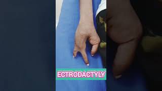 Ectrodactyly Or Split handsplit foot malformationcongenitalanomalygenetics [upl. by Boot]