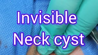 Invisible Neck Cyst Removal rpmhealthclinic [upl. by Kissner403]