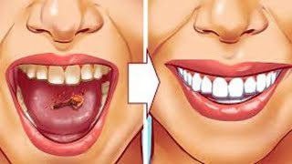 9 Natural Ways to Remove Plaque amp Tartar Buildup  Say Goodbye to Dental Problems [upl. by Adias]