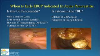 Management of Acute Pancreatitis [upl. by Trepur]