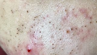 Acne Treatment Huong Da Nang The video has been lost for a long time Remove Blackheads [upl. by Elumas552]