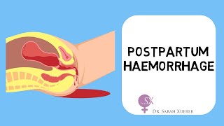 Postpartum Haemorrhage [upl. by Htehpaj]