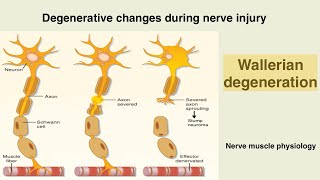 Wallerian degeneration  Nerve injury  peripheral nerve damage [upl. by Giarc]