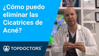 ¿Cómo puedo eliminar las Cicatrices de Acné [upl. by Aniale]