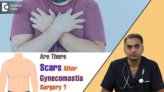 3 Types of Scars After Gynecomastia Surgery  Surgeon Conceals ScarDr Srikanth V  Doctors Circle [upl. by Noval]