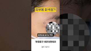 피부에 회색 점 모기질종 핀홀법 수술 후기 핀홀법 피부과 성형외과 병원 nevus pilomatricoma hospital seoul korea아문TV [upl. by Leupold610]