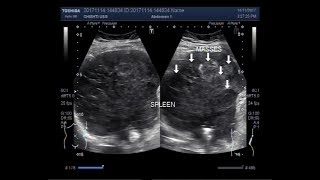 Ultrasound Video showing Hypoechoic splenic lesions [upl. by Inava962]