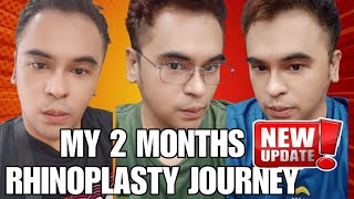 MY 2 MONTHS RHINOPLASTY JOURNEY by Doc Lacson of Kosmed From Day One to 2 Months [upl. by Allerbag215]