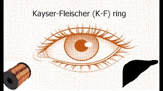 Copper metabolism  Eye Ring  Kayer Fleischer ring I Wilsons disease [upl. by Sirod]