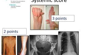 Marfan Syndrome  Diagnosis by Prof Julie De Backer [upl. by Holmun577]