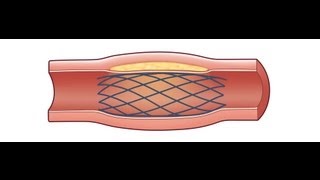 Carotid Stent Healthy Heart with Cardiologist Dr Annie Varughese [upl. by Kelbee]