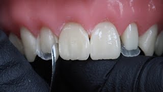 Peg Laterals Restorations with Rhodri Thomas BDS [upl. by Ahseki]