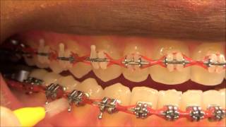 111 HOW TO USE MY INTERDENTAL TOOTHPICKS WITH BRACES ON [upl. by Obmar]