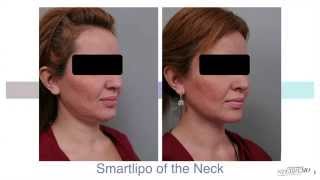 Double Chin Liposuction With Smartlipo™  Dr Sterry Explains [upl. by Henrion]