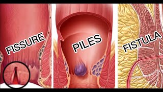 Piles  Fisure  Fistula  Difference explained  Piles vs Fissure vs Fistula  Difference Kiya Hai [upl. by Annunciata]