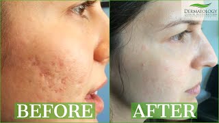 ICE PICK SCAR Acne Results Testimonial  TCA CROSS  Dr Ben Behnam  Los Angeles [upl. by Anneh]