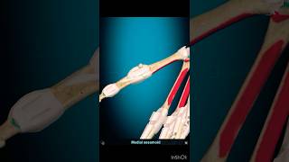 1stMCP dislocation ortho shortvideos youtube india medico [upl. by Lecirg739]