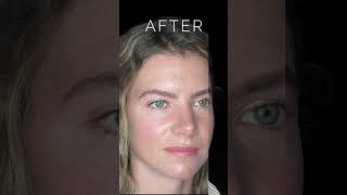 Before amp After Rhinoplasty Surgery Bulbous Tip amp Wide Nose nosejobbeforeandafter nosejobs [upl. by Sammy363]