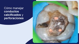 Cómo manejar conductos calcificados y perforaciones [upl. by Josephina]