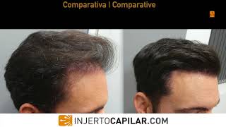 2009 FUE Grafts Repair case Temporal peaks Early regrowth at 5 m 20092017 [upl. by Gnik675]