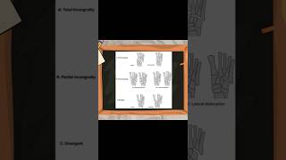 Classification of Lisfranc Injuries lisfranc ortholectures orthopaedics orthodoc ortho [upl. by Eyak]