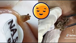 Top 10 Most Satisfying Acne Popping Moments Compilation  Blackheads Cysts amp More [upl. by Scrogan]