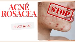 Acné o Rosácea Caso real  ¿Cómo identificarlo SKINCARE [upl. by Creight]