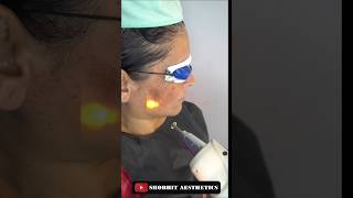 Laser Treatment At Shobhit Aesthetics [upl. by Ymarej]