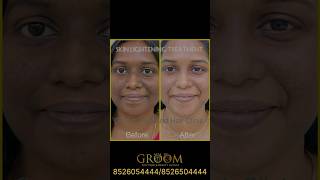 Skin Lightening Treatment Transformation ✨ [upl. by Gunar]