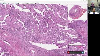 Sclerosing Pneumocytoma Part 2 [upl. by Adaval526]