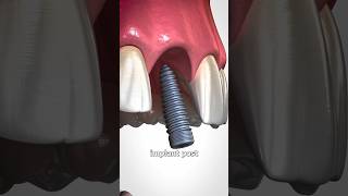 Bone Grafting Explained 🤔 shorts ytshorts storymind [upl. by Iolande478]