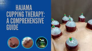 quotExploring Hijama Cupping Therapy A Comprehensive Guidephysiotherapy [upl. by Jobyna435]