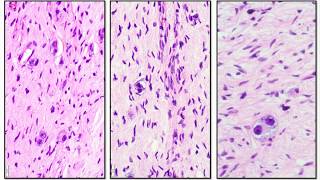 Neuroblastoma and Ganglioneuroma  Adventures in Neuropathology [upl. by Ertemed820]